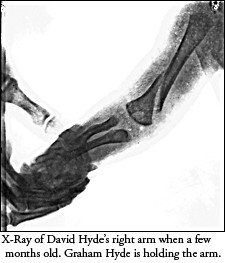 X-Ray )f David Hyde's broken arm when a few months old